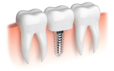 Investing in Your Future: Dental Implants near Truman, MN